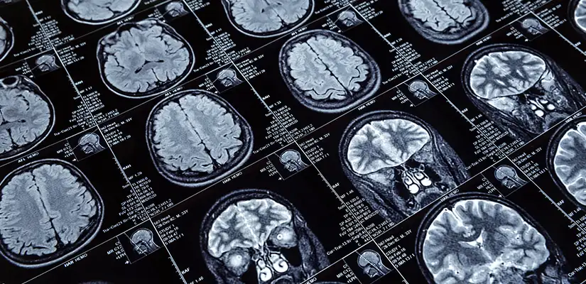 Adult Human Brain Can Generate New Neuronal Cells